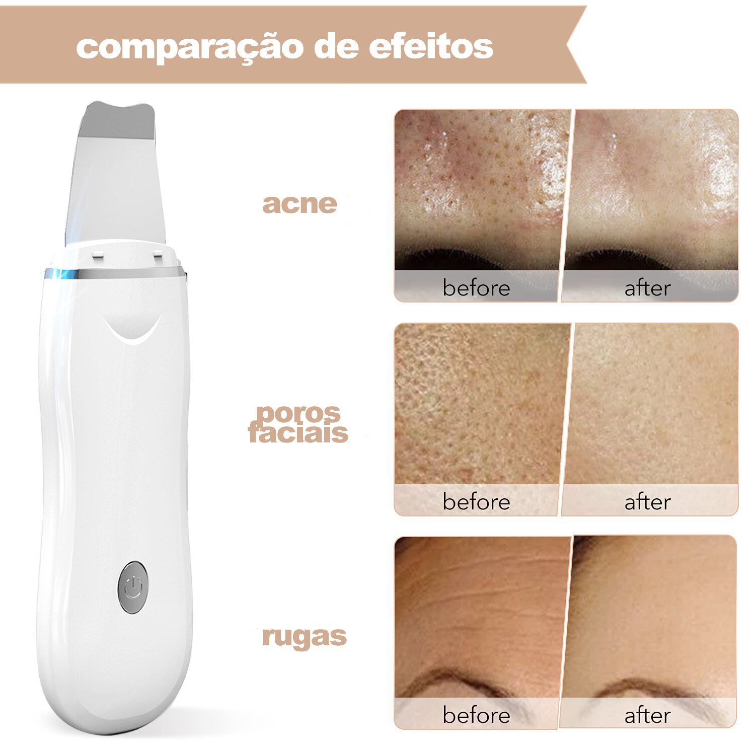 Kit Para Cuidado da Pele - Removedor de Cravo + Peeling Ultrassonico + Purificador da Pele Ultra Sônico