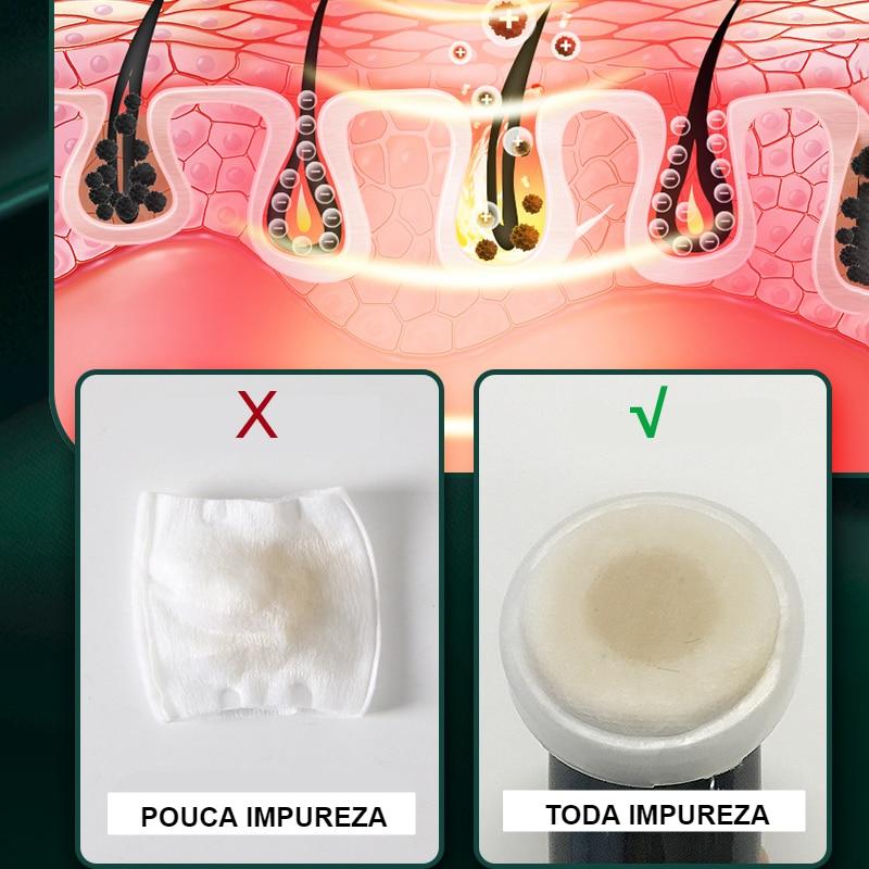 Kit Para Cuidado da Pele - Removedor de Cravo + Peeling Ultrassonico + Purificador da Pele Ultra Sônico